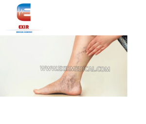 ما هي دوالى الساقين Varicose Veins؟